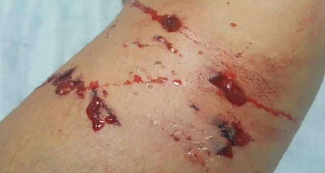 Başı boş köpekler öğrenciyi hastanelik etti